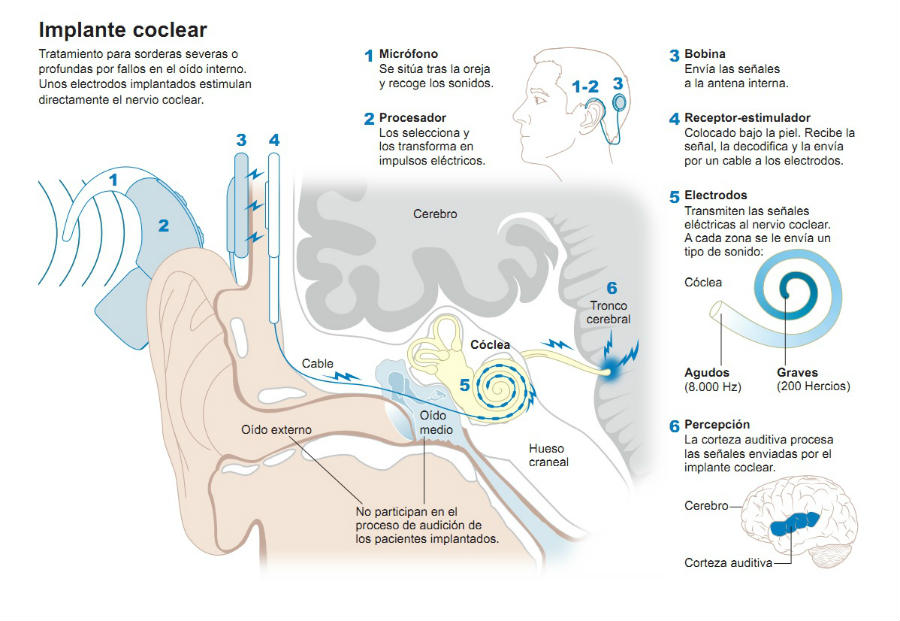 funcionamiento-implante-coclear